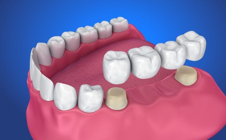 Dental-crown-and-Bridge-768x476.jpg.optimal